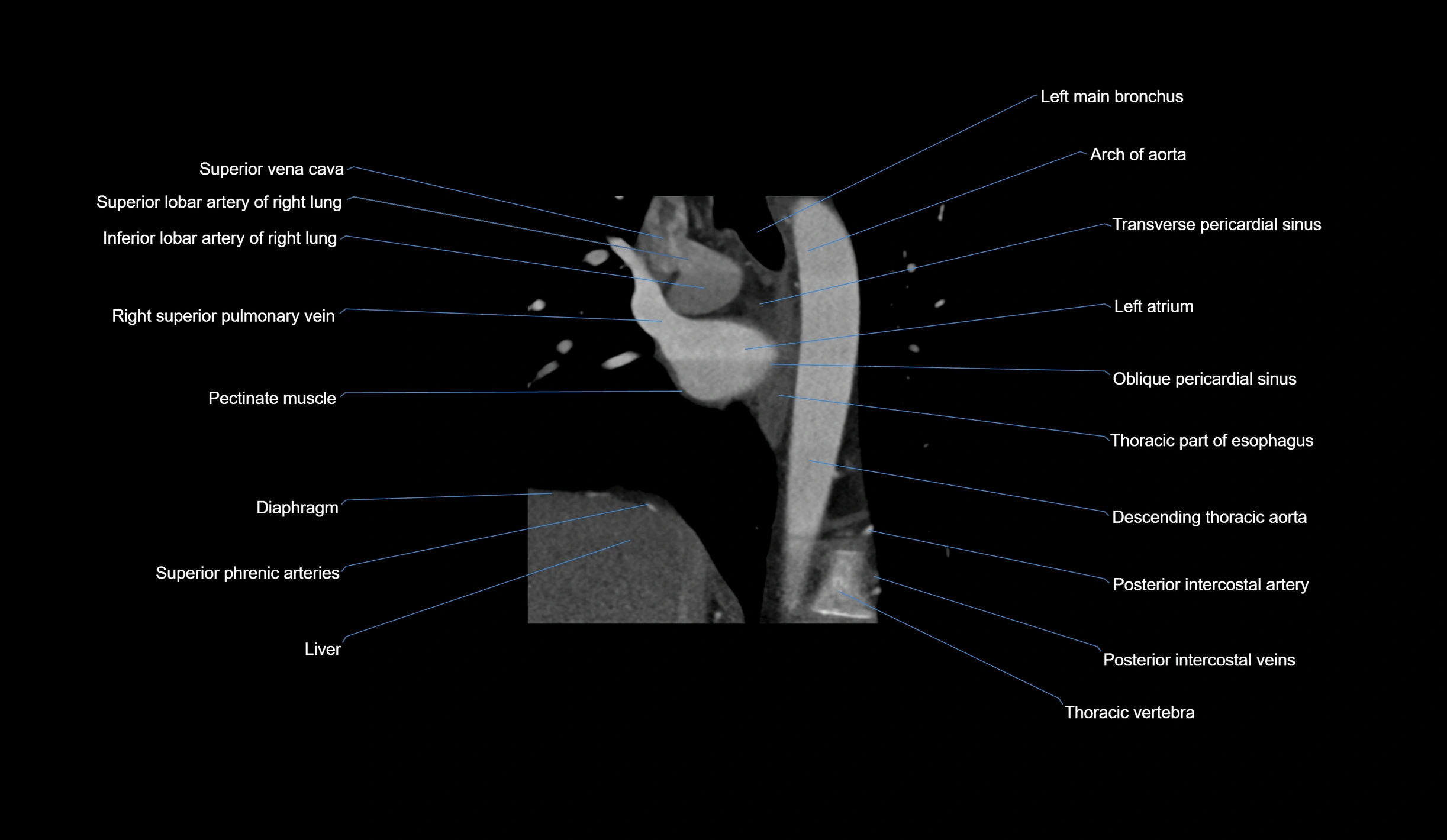 CT heart (coronary angiogram) short axis view  cross sectional anatomy labelled radiology image-00007.webp